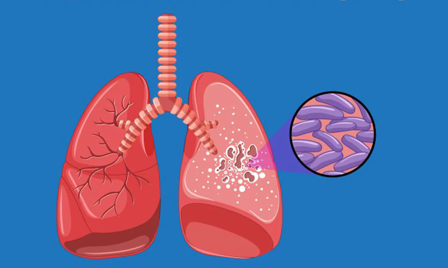 TBC di Indonesia perlu Kolaborasi untuk Penanganannya. (Foto:Dok.pkmbabakansaribdg)