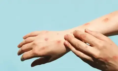 Kasus Cacar Monyet Terus Bertambah, IDI Ingatkan Pentingnya Tingkatkan Kesadaran Masyarakat