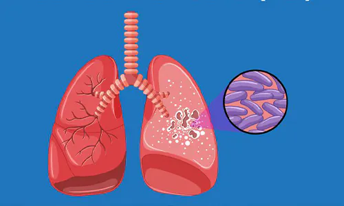 TBC di Indonesia: Pentingnya Kolaborasi dalam Penanganan